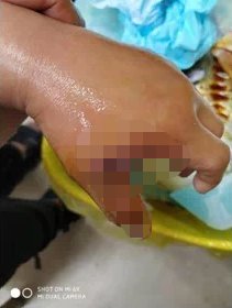 老人养竹鼠哄孙子,5岁男孩左手被咬,伤口深部感染坏死