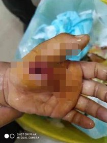 老人养竹鼠哄孙子,5岁男孩左手被咬,伤口深部感染坏死