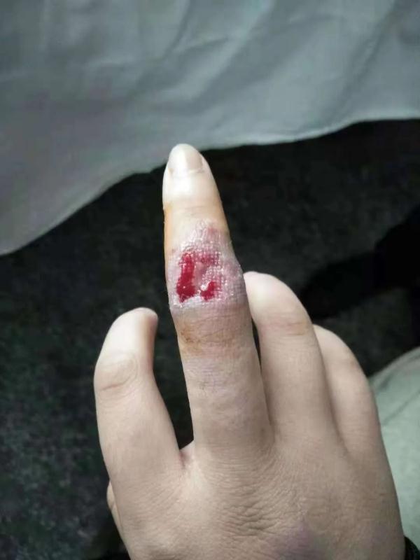 温州一女子洗虾被扎伤，手指红肿溃烂，医生紧急提醒