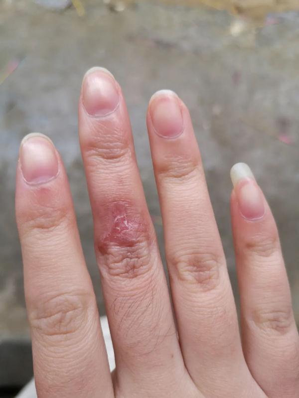 温州一女子洗虾被扎伤,手指红肿溃烂,医生紧急提醒