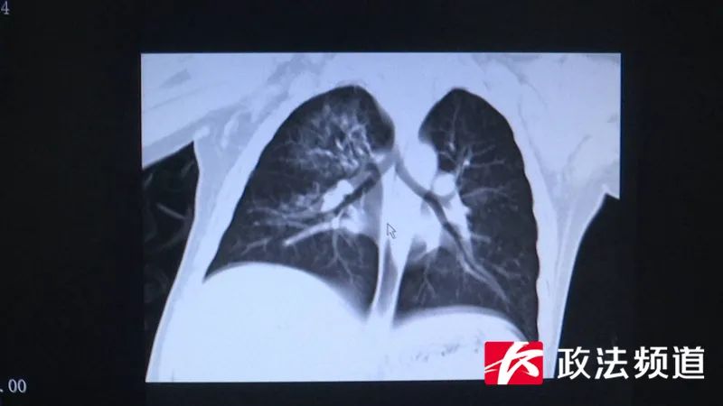 揪心!长沙2岁男童掉入正在运转的洗衣机内,肺部感染10种细菌