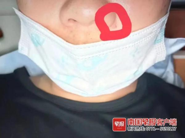 挤了一颗痘痘，南宁一男子被下病重通知书