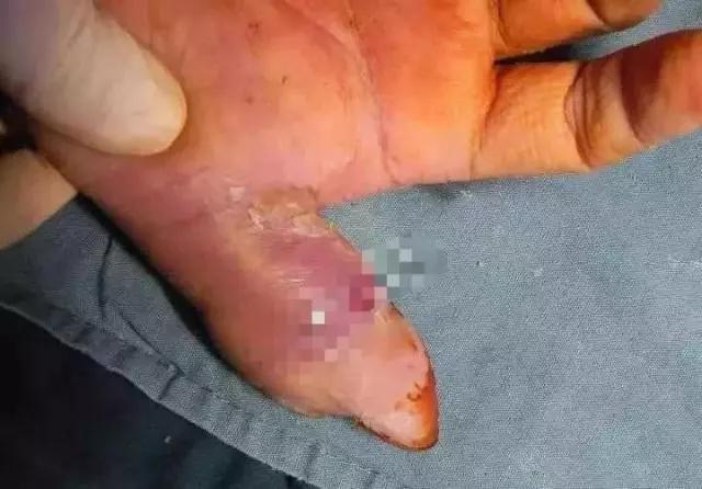 武汉52岁的周师傅,劝架意外被咬,右手拇指不小心被别人的牙齿撞破了个