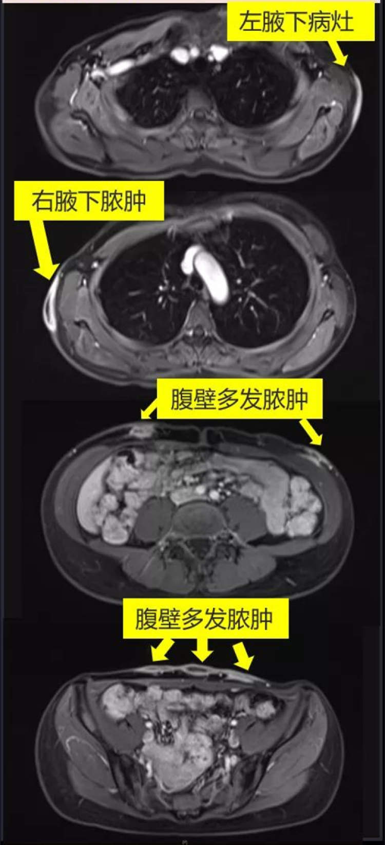 “埋线瘦身”术后，她感染神秘细菌！感染科专家：埋线治疗后感染病例增多  | 申晨间