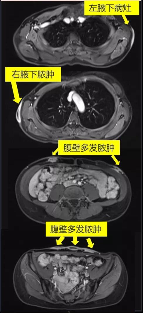 “埋线瘦身”术后，她感染神秘细菌！感染科专家：埋线治疗后感染病例增多  | 申晨间